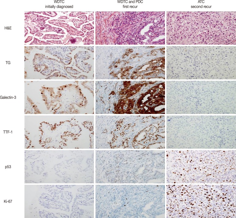 Anaplastic Transformation of Papillary Thyroid Carcinoma in a Young Man: A Case Study with Immunohistochemical and BRAF Analysis.