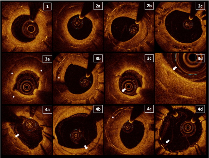 Optical coherence tomography characteristics of in-stent restenosis are different between first and second generation drug eluting stents