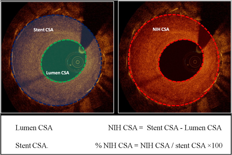 Optical coherence tomography characteristics of in-stent restenosis are different between first and second generation drug eluting stents