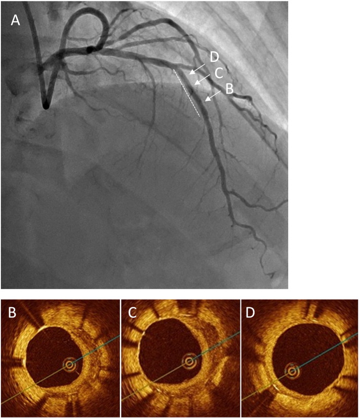 Difference of vascular response between everolimus- and paclitaxel-eluting stents for small coronary artery disease: Optical coherence tomography analysis