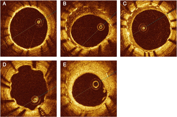 Difference of vascular response between everolimus- and paclitaxel-eluting stents for small coronary artery disease: Optical coherence tomography analysis