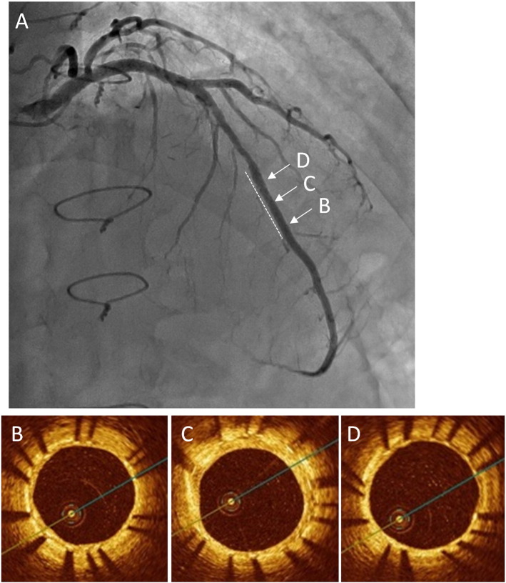 Difference of vascular response between everolimus- and paclitaxel-eluting stents for small coronary artery disease: Optical coherence tomography analysis