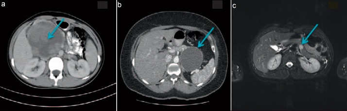 Solid Pseudopapillary Neoplasm of the Pancreas: Analysis of Seven Cases.