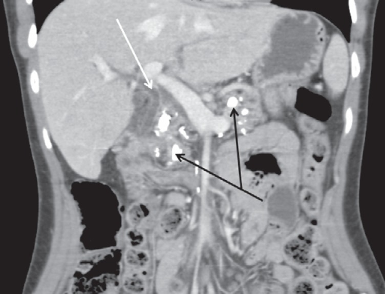 The Pancreas: Causes for Malabsorption.