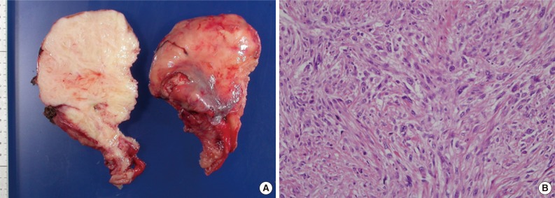 Dedifferentiated solitary fibrous tumor of thoracic cavity.