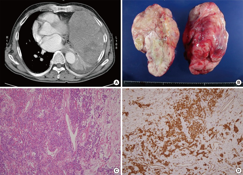 Dedifferentiated solitary fibrous tumor of thoracic cavity.