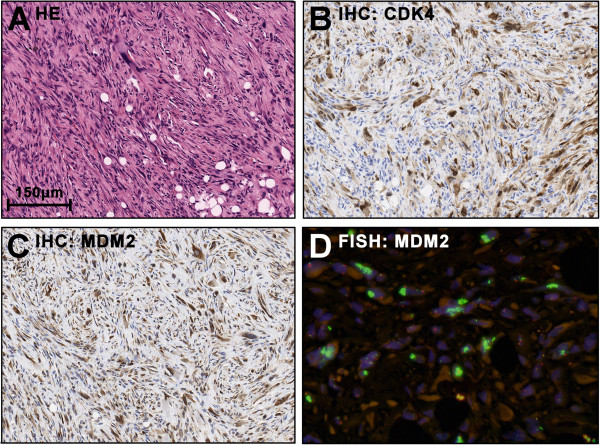 Challenging dedifferentiated liposarcoma identified by MDM2-amplification, a report of two cases.