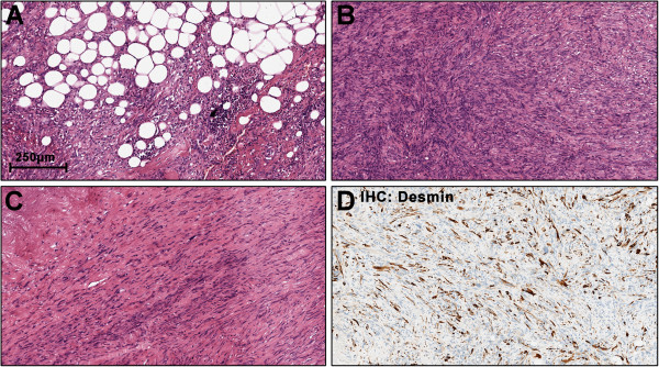 Challenging dedifferentiated liposarcoma identified by MDM2-amplification, a report of two cases.