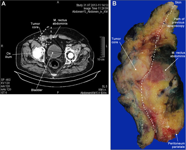 Challenging dedifferentiated liposarcoma identified by MDM2-amplification, a report of two cases.