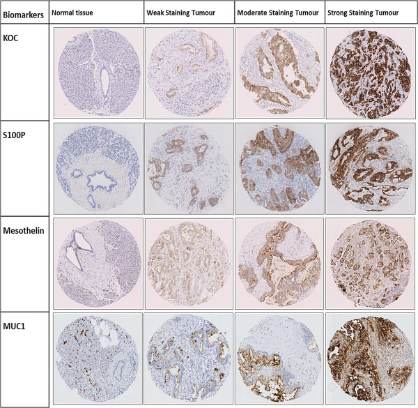 Expression of KOC, S100P, mesothelin and MUC1 in pancreatico-biliary adenocarcinomas: development and utility of a potential diagnostic immunohistochemistry panel.