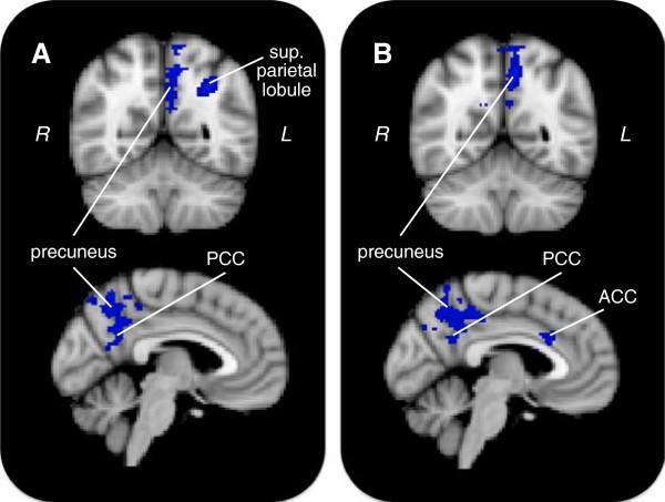 Increased default mode network activity in socially anxious individuals during reward processing.