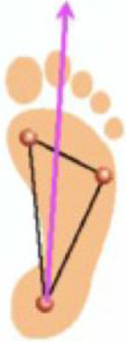 Osteomyelitis in the diabetic foot.