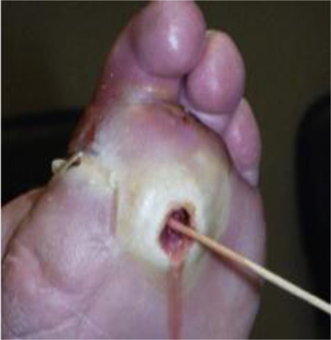 Osteomyelitis in the diabetic foot.