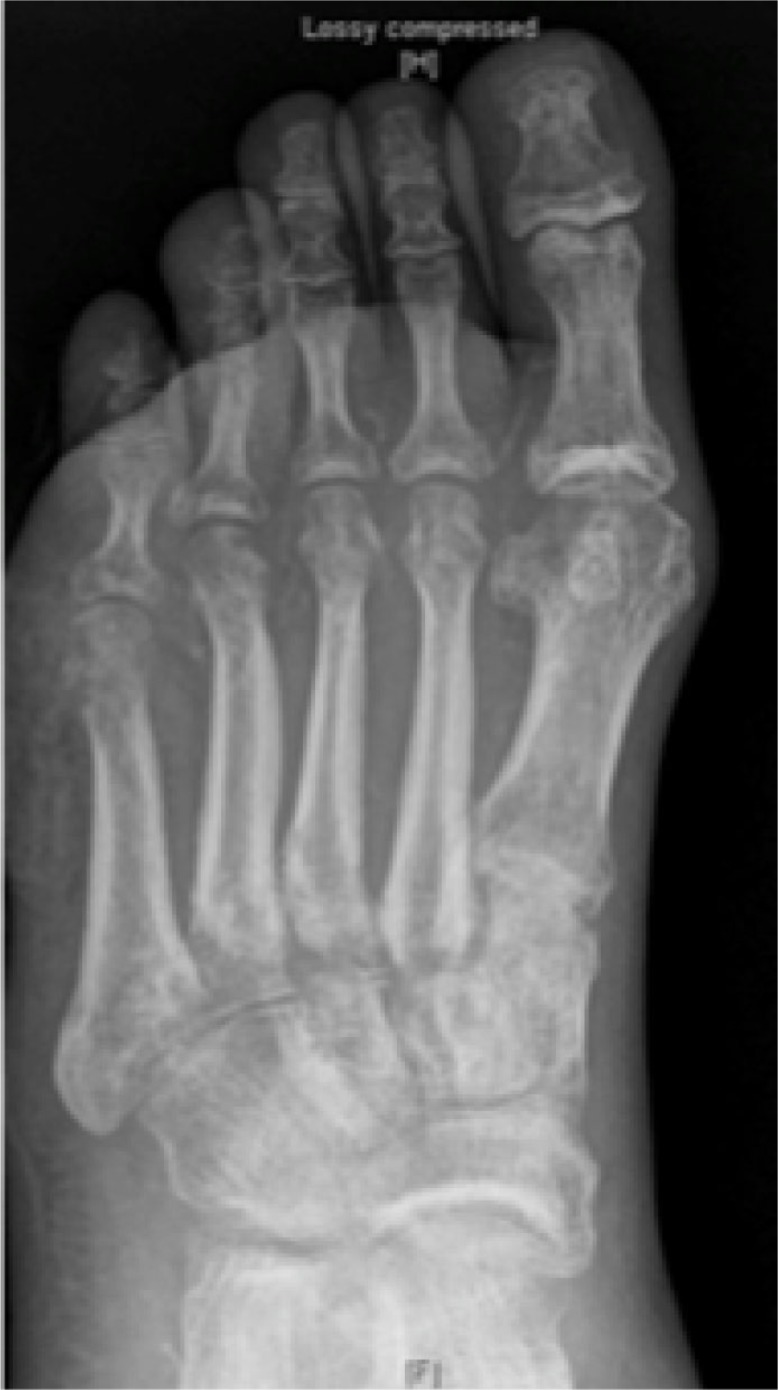 Osteomyelitis in the diabetic foot.