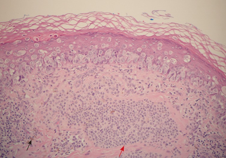 Unilateral Pigmented Extramammary Paget's Disease of the Axilla Associated with a Benign Mole: A Case Study and a Review of Literature.