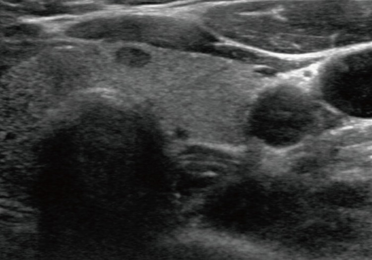 Inflammatory myofibroblastic tumor of the thyroid gland: a brief case report.