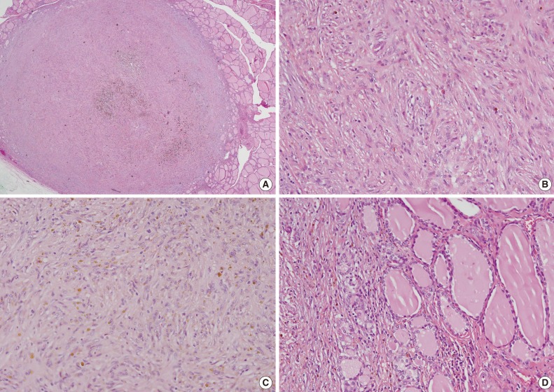 Inflammatory myofibroblastic tumor of the thyroid gland: a brief case report.