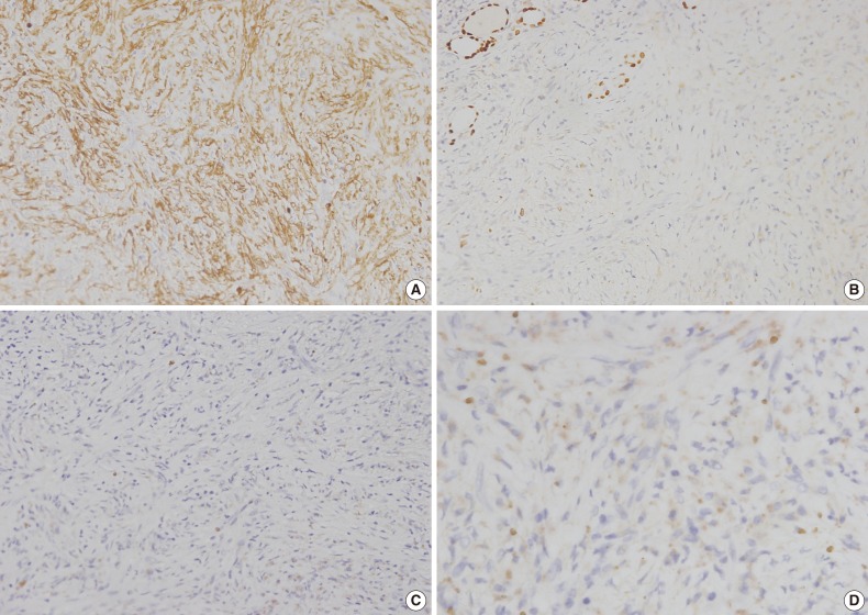 Inflammatory myofibroblastic tumor of the thyroid gland: a brief case report.