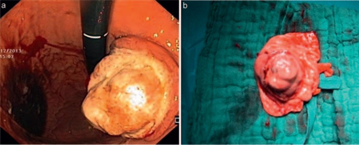 Gastric Metastasis of Malignant Melanoma: Report of a Case and Review of Available Literature.