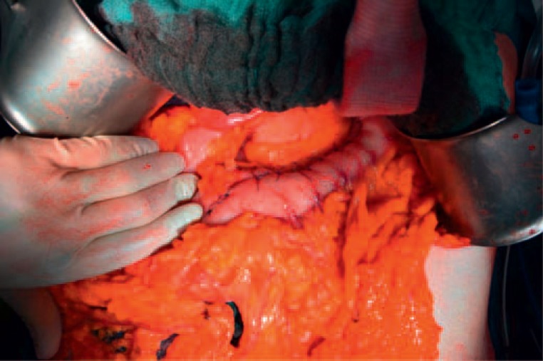 Gastric Metastasis of Malignant Melanoma: Report of a Case and Review of Available Literature.