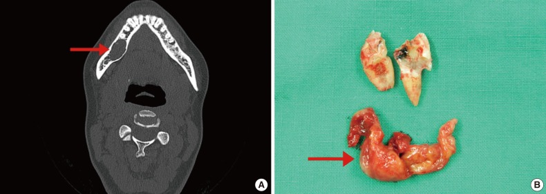 Solitary myofibroma of the adult mandible: a case report and review of literature.