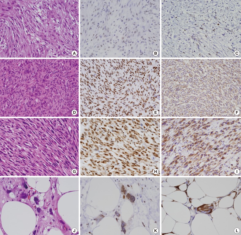 Expression of HuR and Cyclooxygenase-2 in Nodular Fasciitis and Low-Grade Sarcoma: An Immunohistochemical Study.