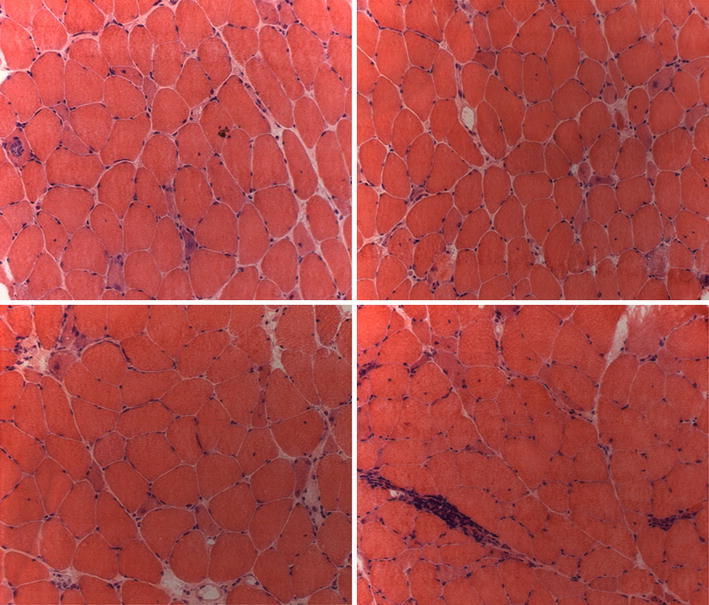 Myositis autoantibodies and clinical phenotypes.