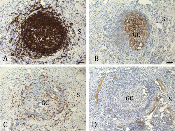 Characterisation and prognostic value of tertiary lymphoid structures in oral squamous cell carcinoma.