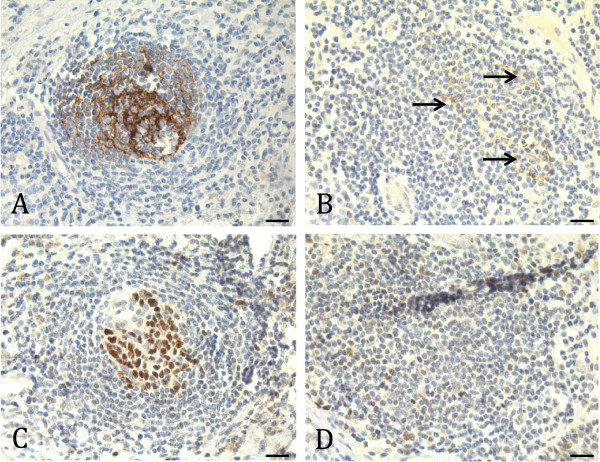 Characterisation and prognostic value of tertiary lymphoid structures in oral squamous cell carcinoma.