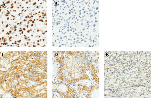 P53 nuclear stabilization is associated with FHIT loss and younger age of onset in squamous cell carcinoma of oral tongue.