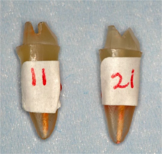 Effect of tapering internal coronal walls on fracture resistance of anterior teeth treated with cast post and core: In vitro study.