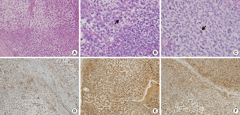 Undifferentiated embryonal sarcoma in adult liver.