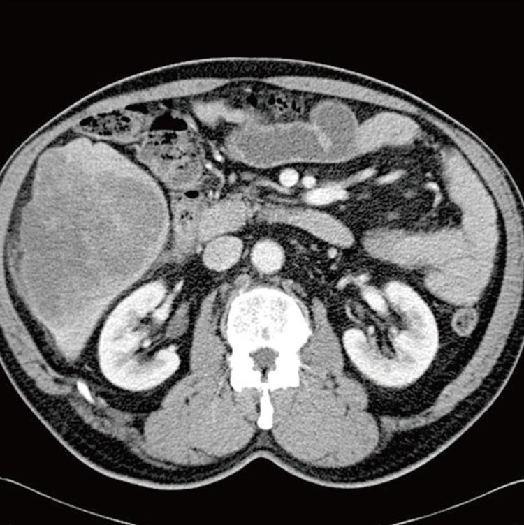 Undifferentiated embryonal sarcoma in adult liver.