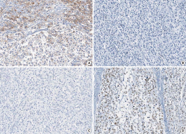 Differential Features of Microsatellite-Unstable Colorectal Carcinomas Depending on EPCAM Expression Status.