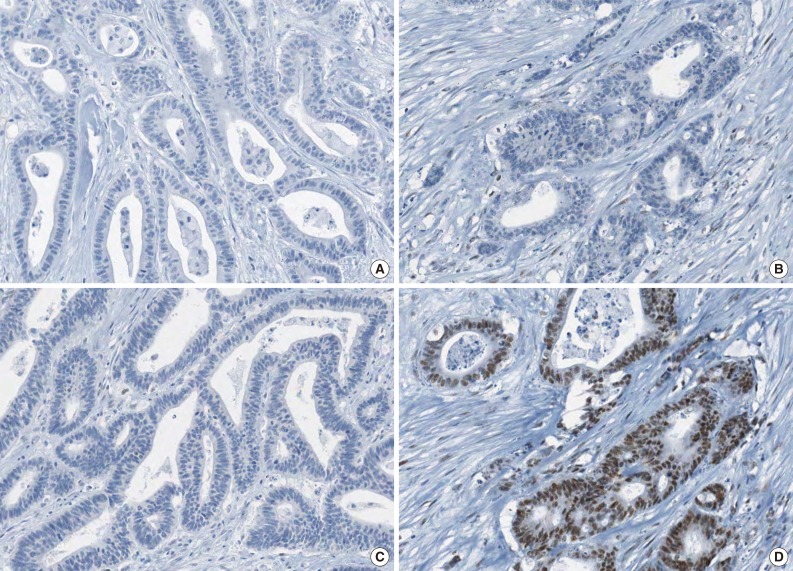 Differential Features of Microsatellite-Unstable Colorectal Carcinomas Depending on EPCAM Expression Status.