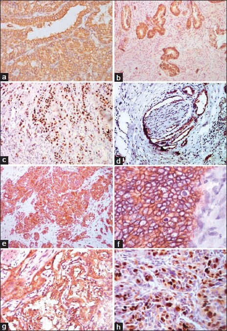 Expression of epidermal growth factor receptor, p53, Bcl2, vascular endothelial growth factor, cyclooxygenase-2, cyclin D1, human epidermal receptor-2 and Ki-67: Association with clinicopathological profiles and outcomes in gallbladder carcinoma.