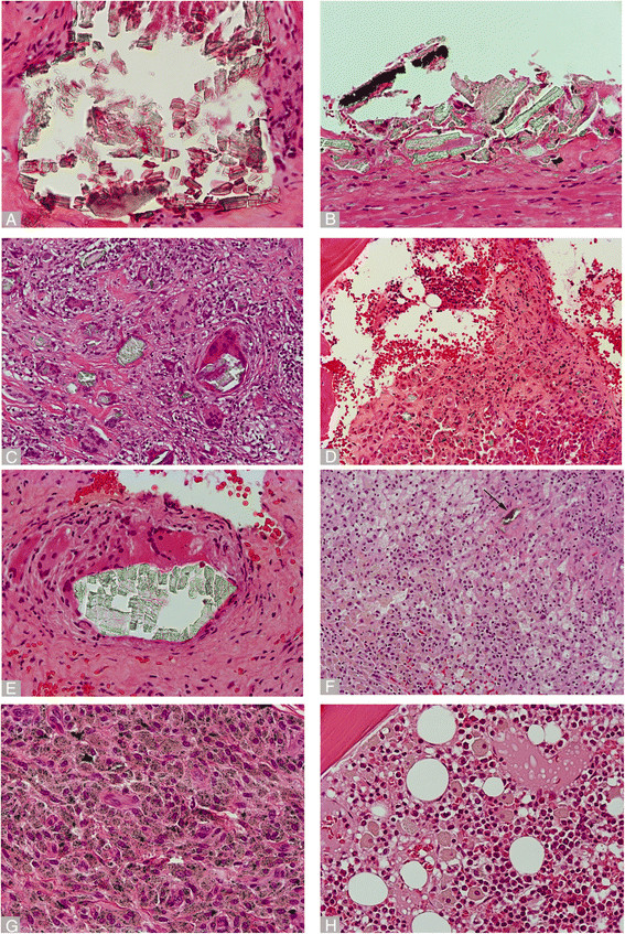 Implant based differences in adverse local tissue reaction in failed total hip arthroplasties: a morphological and immunohistochemical study.