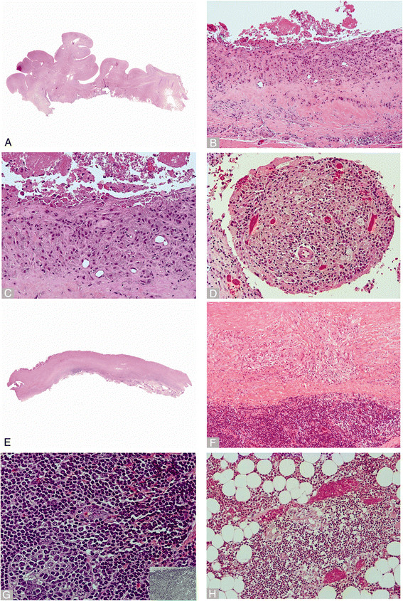 Implant based differences in adverse local tissue reaction in failed total hip arthroplasties: a morphological and immunohistochemical study.