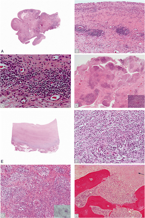 Implant based differences in adverse local tissue reaction in failed total hip arthroplasties: a morphological and immunohistochemical study.