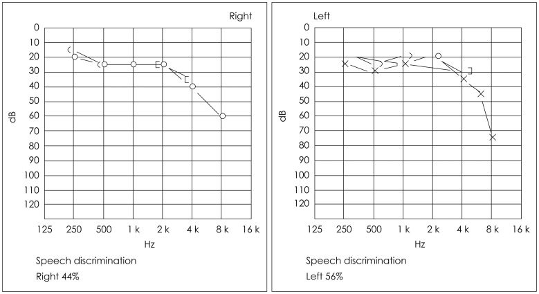 A case of acute bilateral retrocochlear hearing loss as an initial symptom of unilateral thalamic hemorrhage.