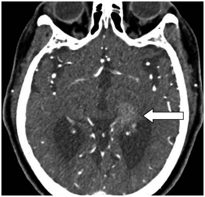 A case of acute bilateral retrocochlear hearing loss as an initial symptom of unilateral thalamic hemorrhage.