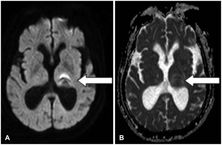A case of acute bilateral retrocochlear hearing loss as an initial symptom of unilateral thalamic hemorrhage.