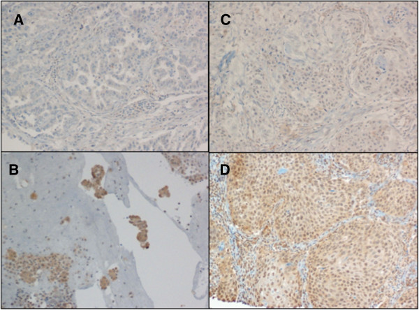 P2X7 protein expression and polymorphism in non-small cell lung cancer (NSCLC).