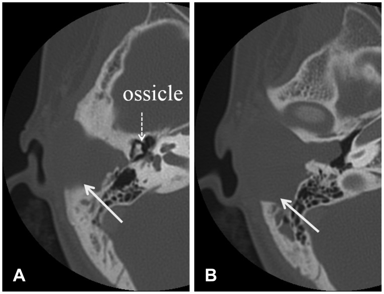 A case of a cholesterol granuloma occluding the external auditory canal in a 12-year-old girl.