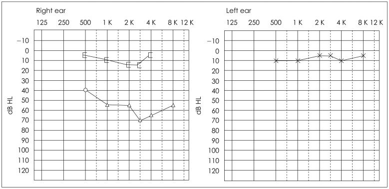 A case of a cholesterol granuloma occluding the external auditory canal in a 12-year-old girl.