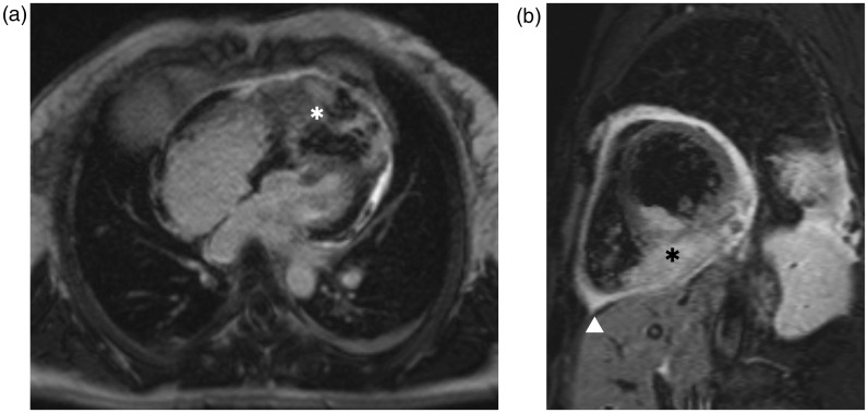Diagnosis of cardiac metastasis from cervical cancer in a 33-year-old patient using multimodal imaging studies: a case report and literature review.