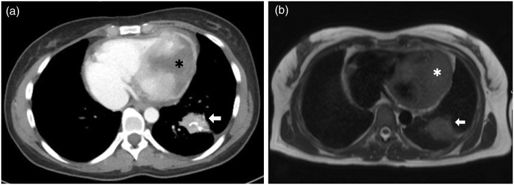 Diagnosis of cardiac metastasis from cervical cancer in a 33-year-old patient using multimodal imaging studies: a case report and literature review.