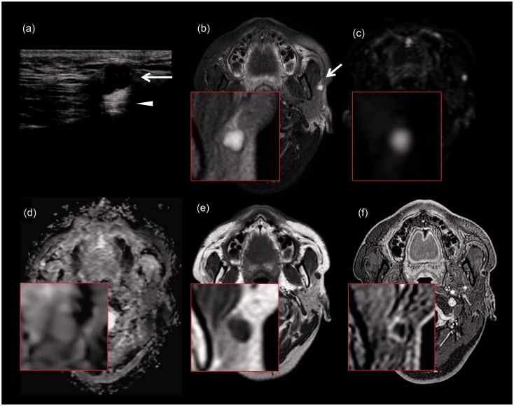 Radiological images of keratocystoma: a rare tumor of the parotid gland.