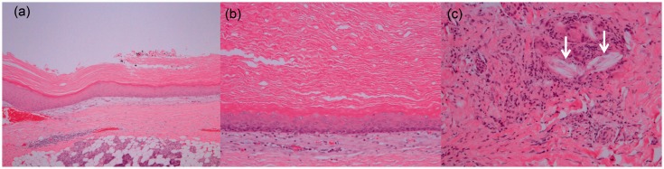 Radiological images of keratocystoma: a rare tumor of the parotid gland.