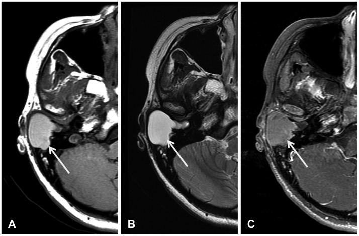 A case of a cholesterol granuloma occluding the external auditory canal in a 12-year-old girl.